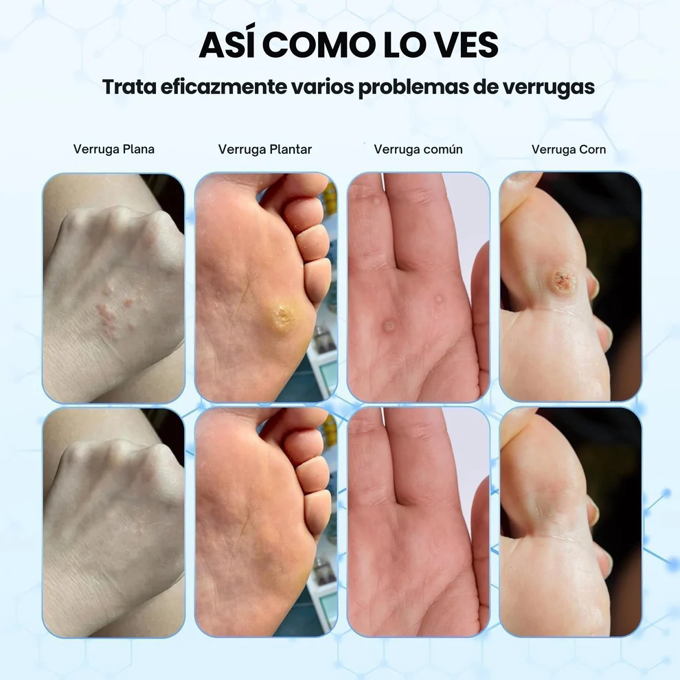 Wart Removedor™ - Removedor de Verrugas